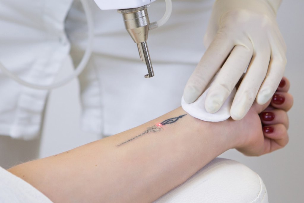 Enlever un Tatouage : Techniques et Conseils à Aix-en-Provence