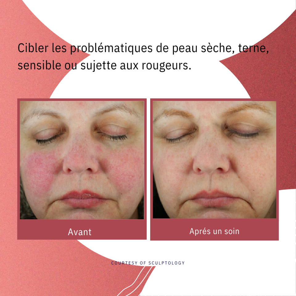 Traitement des rougeurs avec GlacialSkin